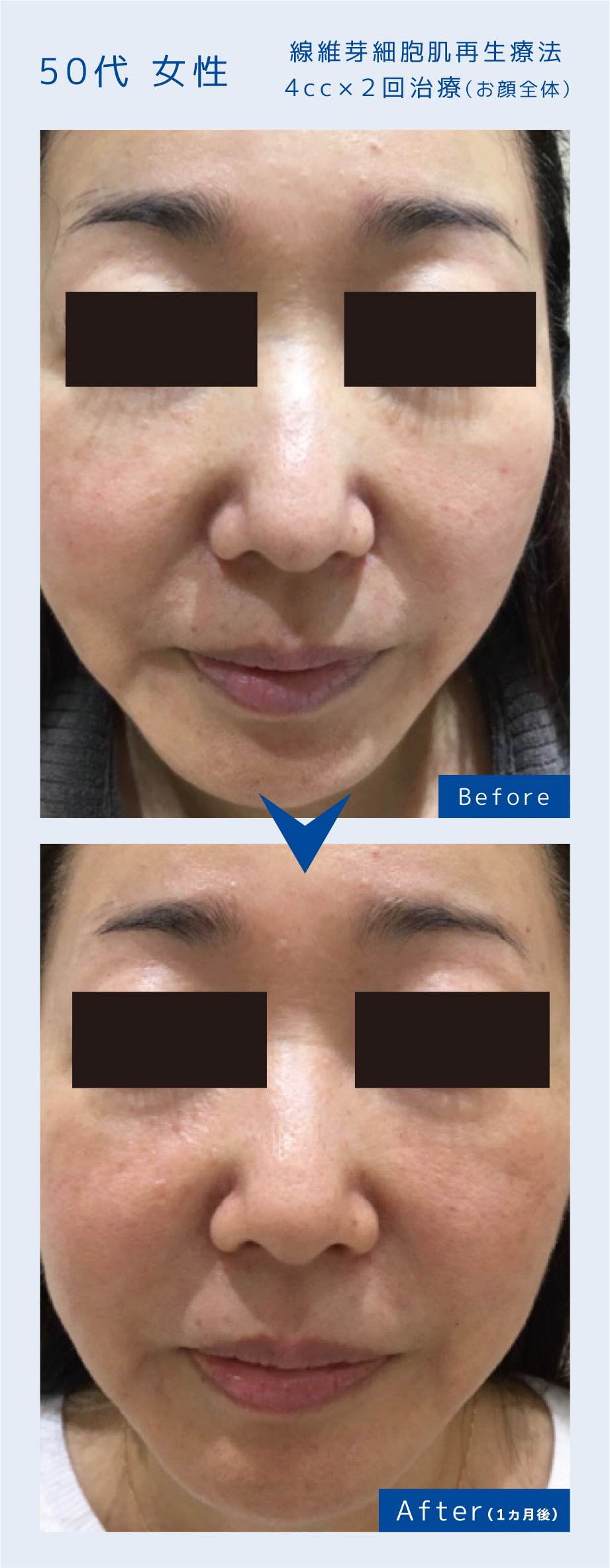 線維芽細胞肌再生療法4cc×２回治療（お顔全体）50代 女性