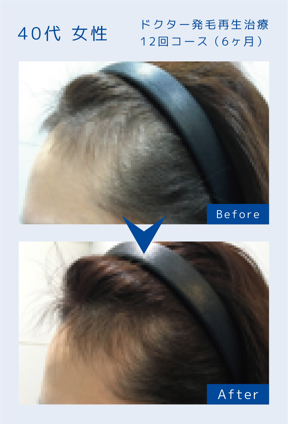 ドクター発毛再生治療6回コース（6ヶ月）