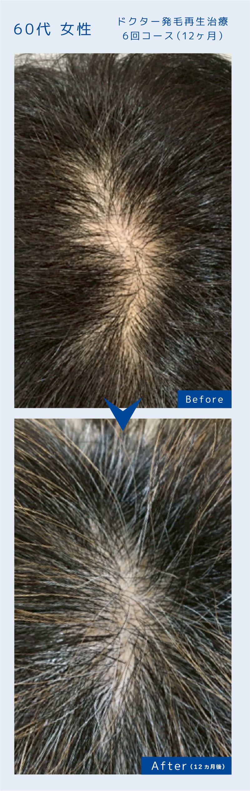 ドクター発毛再生治療6回コース（12ヶ月）