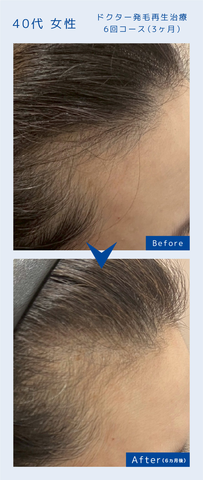ドクター発毛再生治療6回コース（3ヶ月）