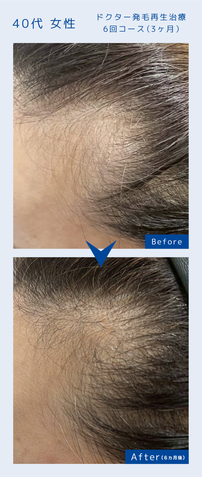 ドクター発毛再生治療6回コース（3ヶ月）