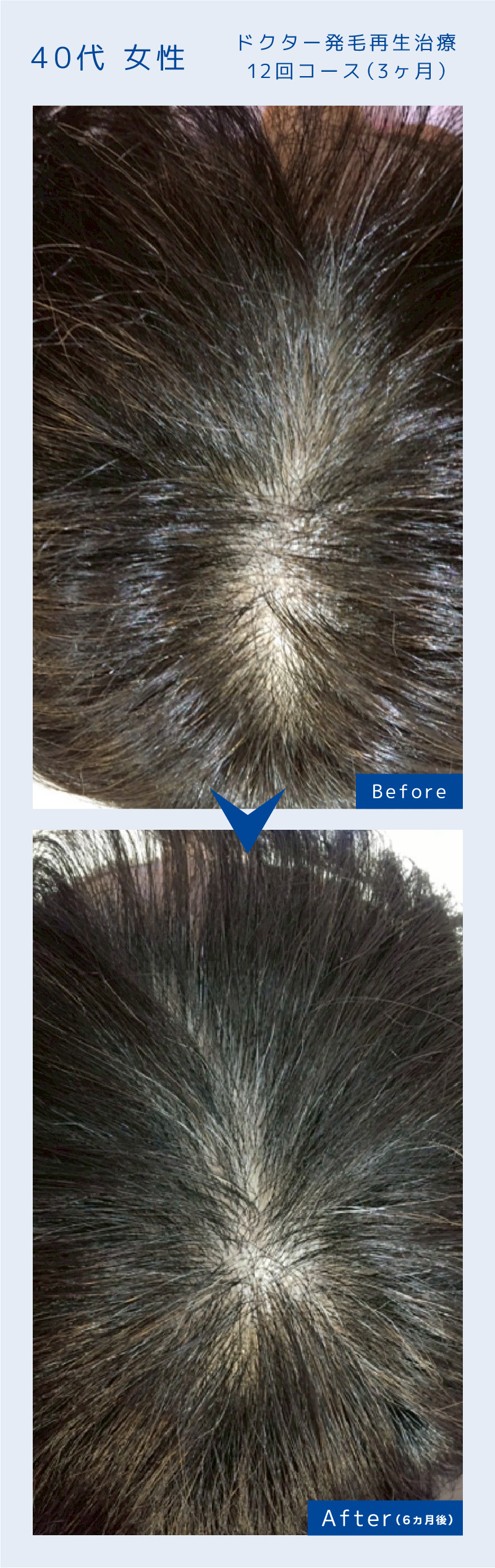 ドクター発毛再生治療12回コース（3ヶ月）