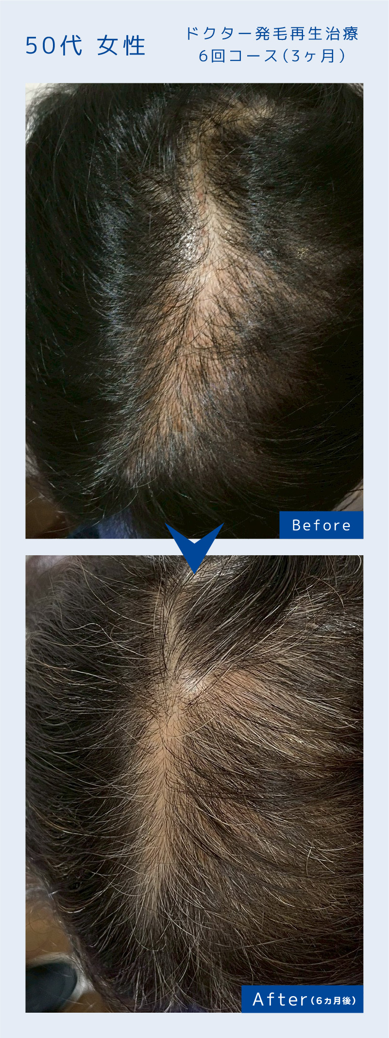 ドクター発毛再生治療6回コース（3ヶ月）