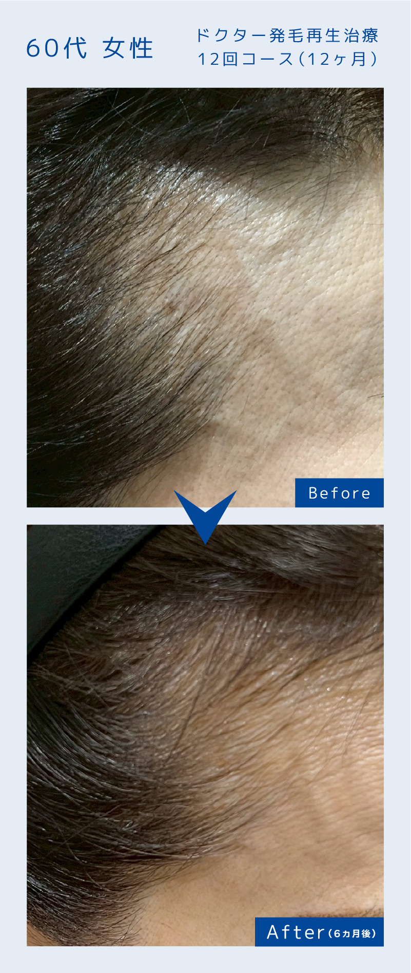 ドクター発毛再生治療12回コース（12ヶ月）