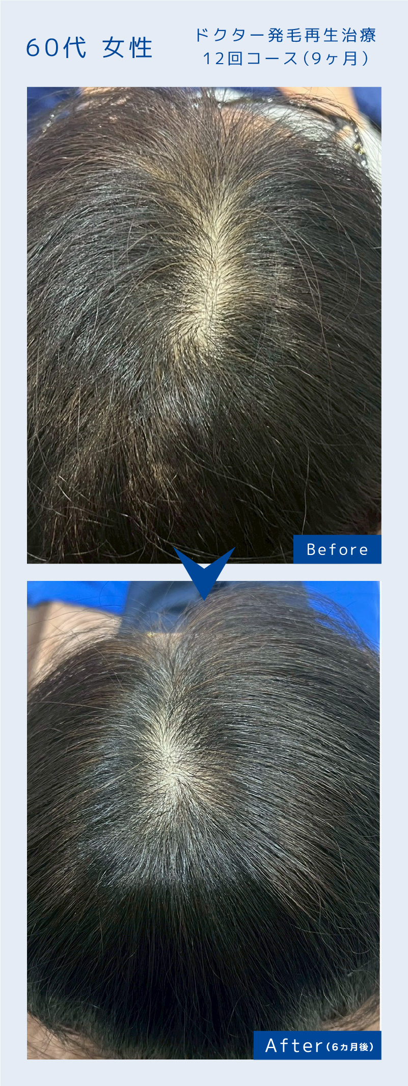 ドクター発毛再生治療12回コース（9ヶ月）