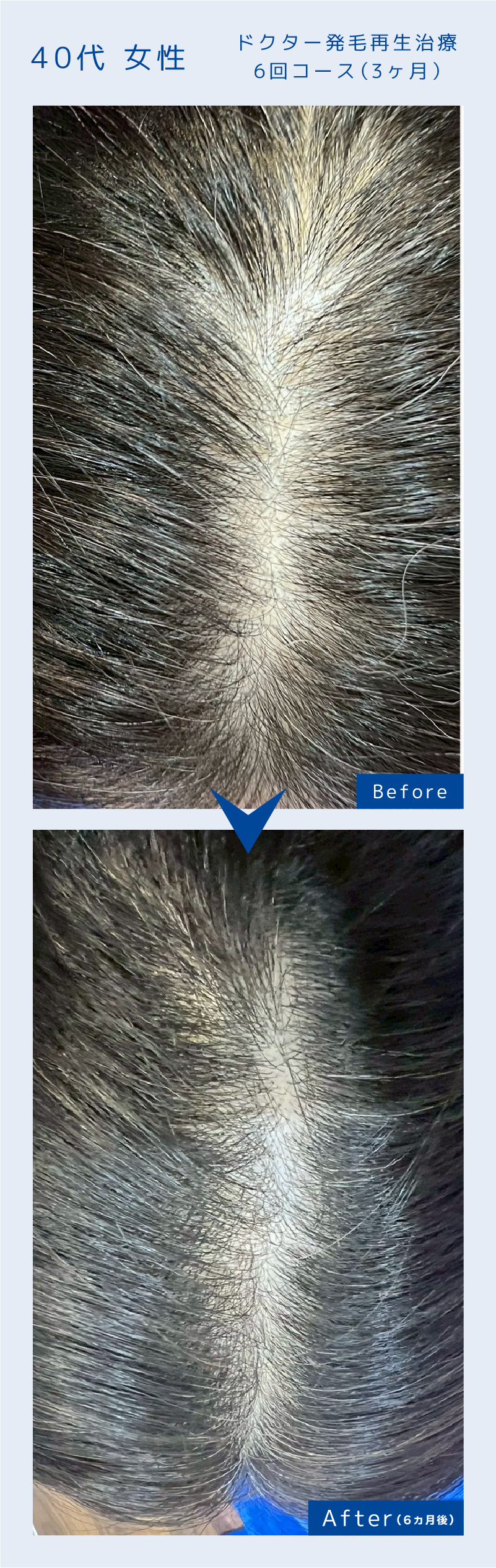 ドクター発毛再生治療6回コース（3ヶ月）