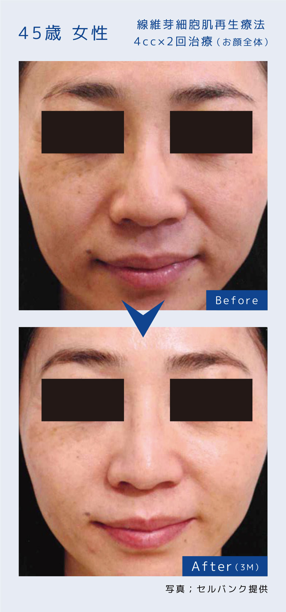線維芽細胞肌再生療法4cc×2回治療（お顔全体）45歳 女性