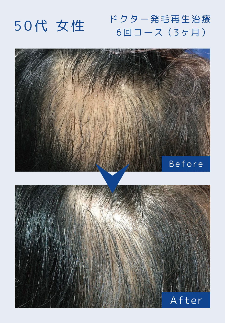 ドクター発毛再生治療6回コース（3ヶ月）
