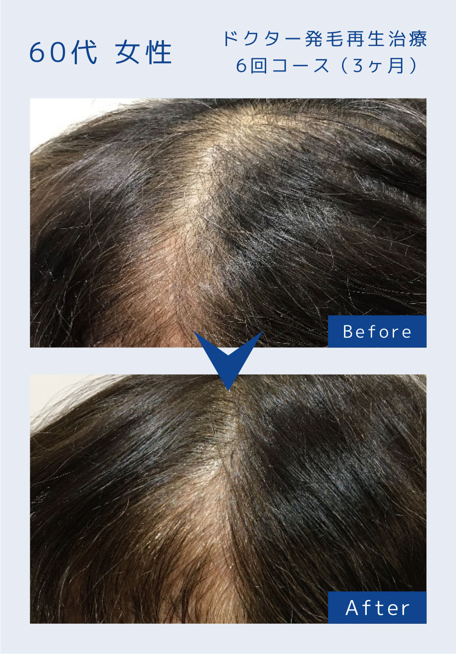 ドクター発毛再生治療6回コース（3ヶ月）