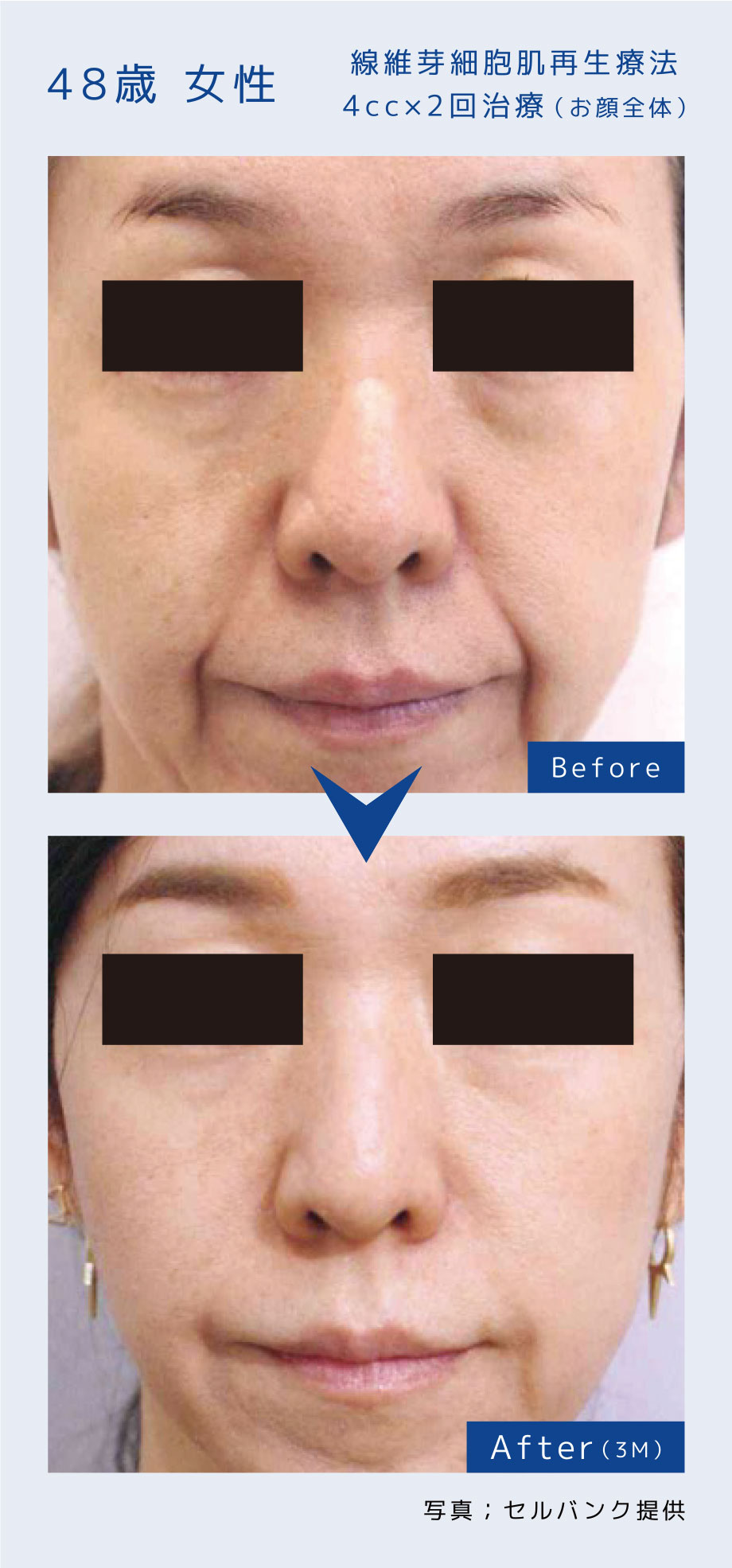 線維芽細胞肌再生療法4cc×2回治療（お顔全体）48歳 女性