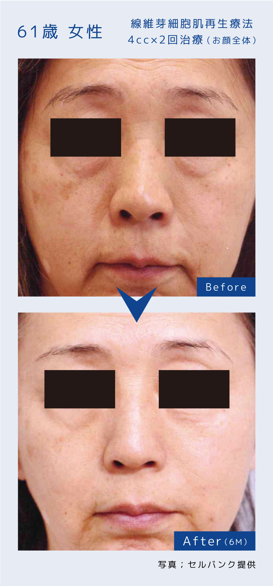 線維芽細胞肌再生療法4cc×2回治療（お顔全体）61歳 女性